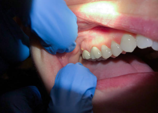 Best Cracked Tooth Emergency Dentist  in Ponderay, ID